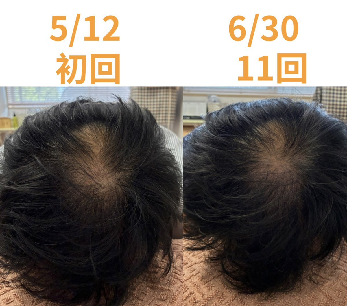 当院で薄毛改善鍼を受けた方の経過（頭頂部・初回から11回目）