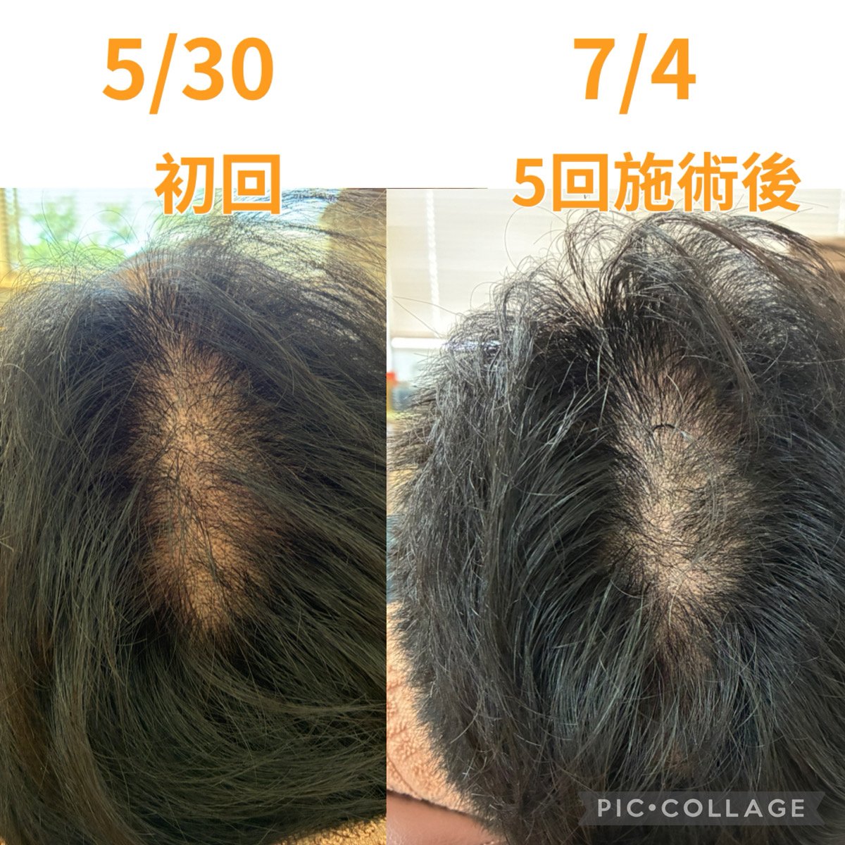 当院で薄毛改善鍼を受けた方の頭皮環境の経過（初回から5回施術後）
